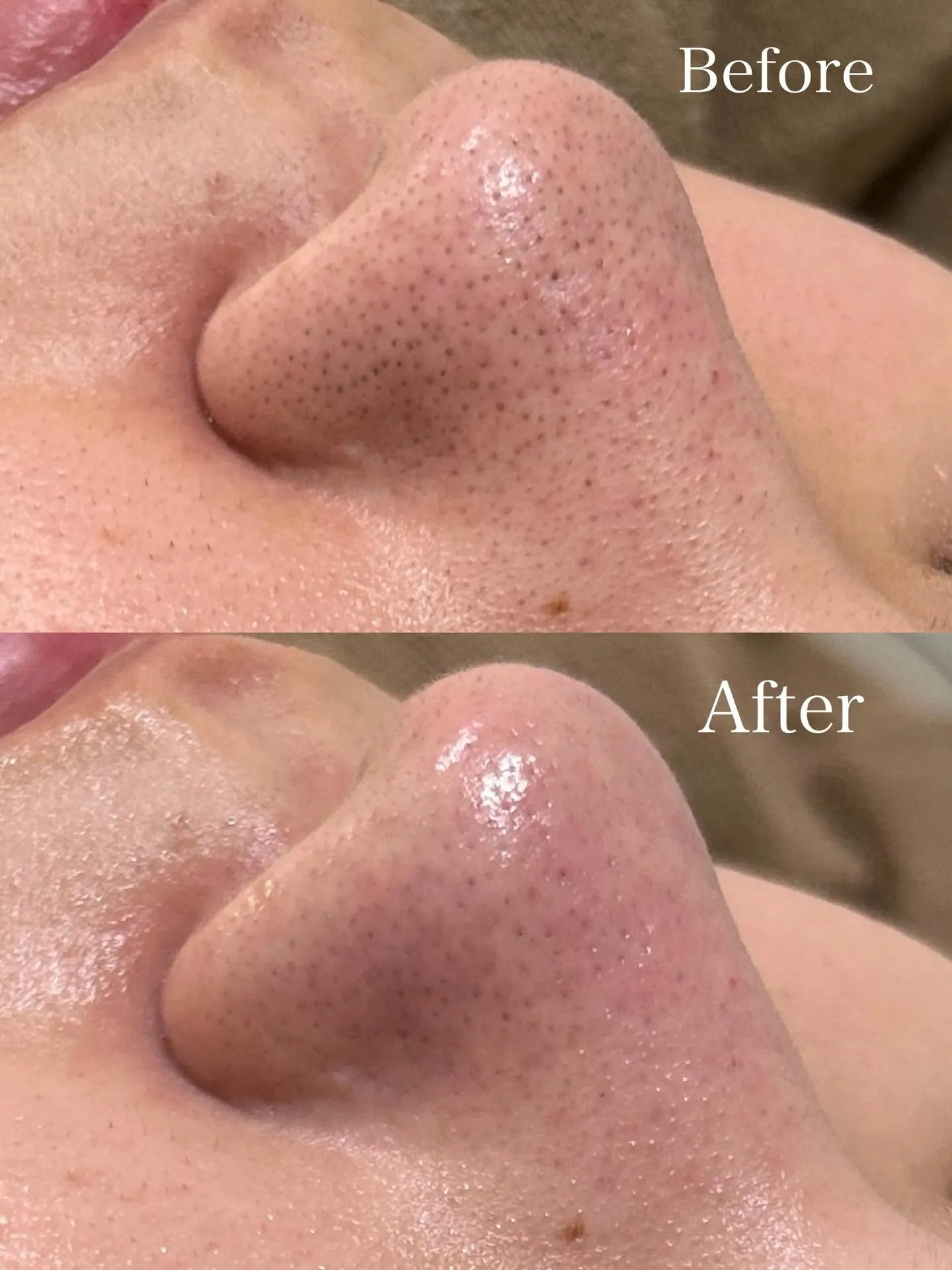 鼻の毛穴の黒ずみに悩まれていた20代前半のお客様✨